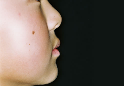 歯列矯正初診時　口元