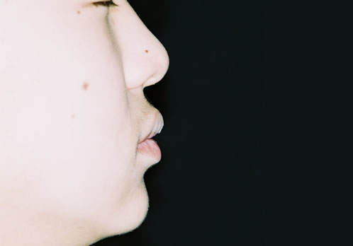 歯列矯正終了時　口元